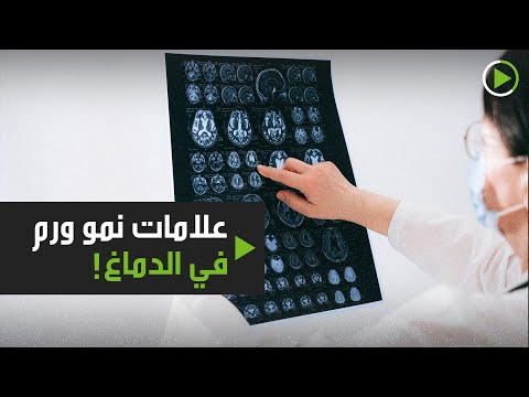 شاهد 6 علامات تُشير إلى نمو ورم في الدماغ